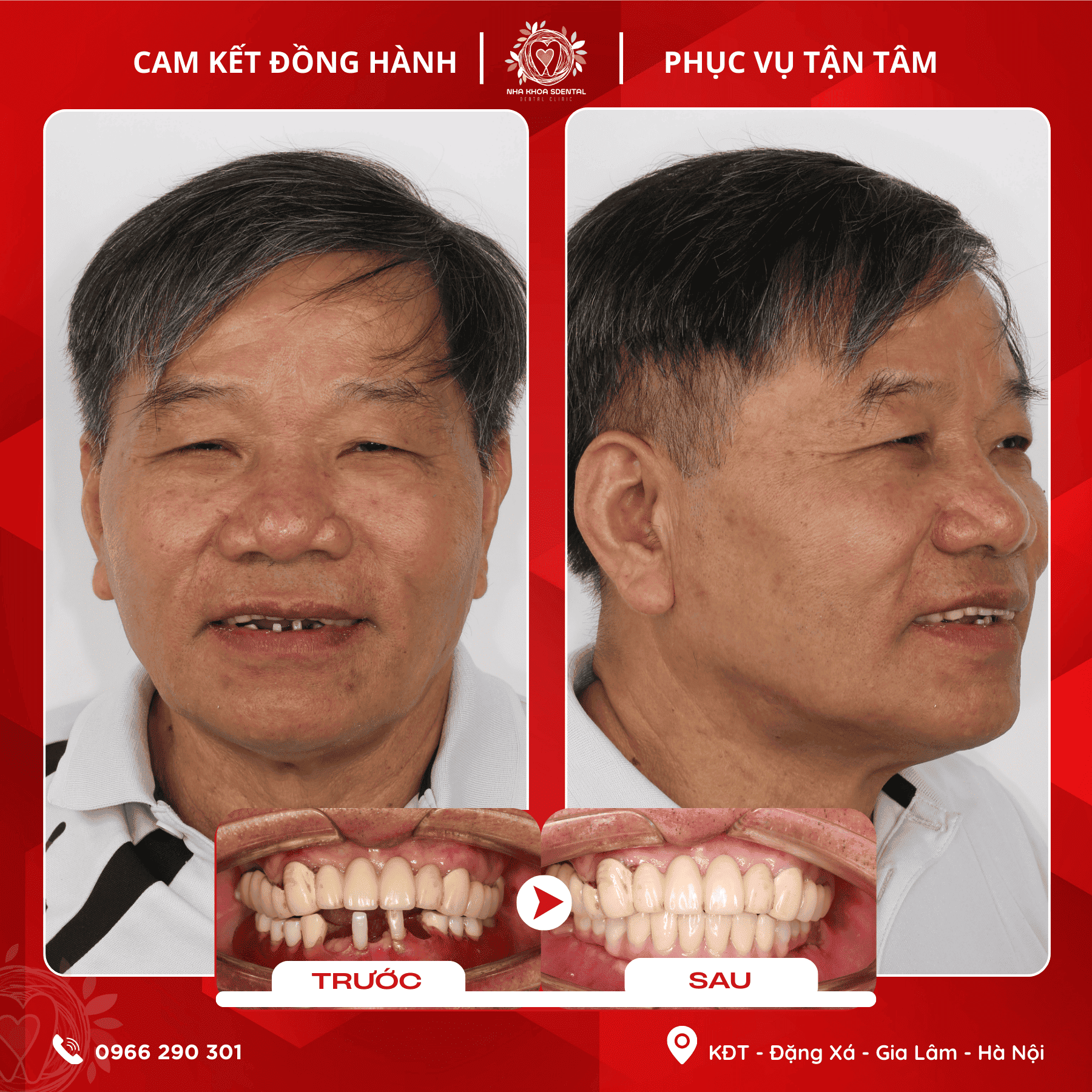 Mất Răng Toàn Hàm Và Hành Trình Trồng Răng Implant Cho Chú Hoàng Văn Tôn (Việt Kiều Úc) Tại Nha Khoa S-Dental